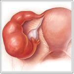 воспалительные заболевания женских половых органов