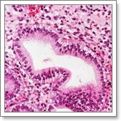 конизация шейки матки, гистология