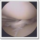 артроскопия коленного сустава