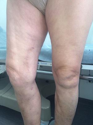 Результат лечения варикозного расширения вен методом венэктомии