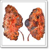 лечение кисты почки