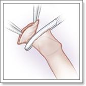 лечение фимоза