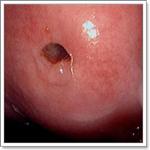 киста шейки матки