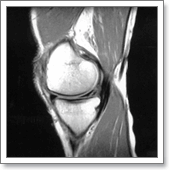разрыв мениска