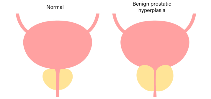 Аденома простаты