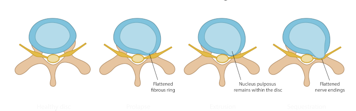 Стадии межпозвоночныой грыжи Стадии межпозвоночныой грыжи