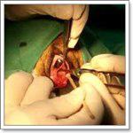 хирургическое лечение бартолинита