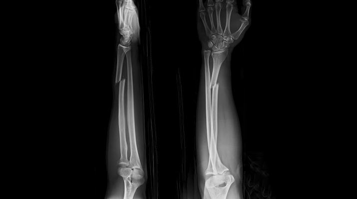 Перелом лучевой кости