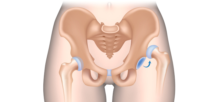 Вывих бедра