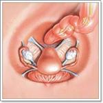 Пельвиоперитонит