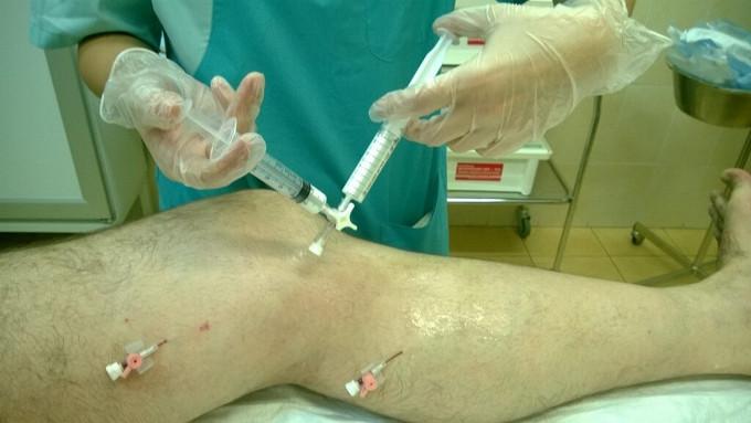 Склеротерапия