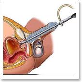 лечение склероза предстательной железы