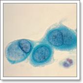 Хламидиоз, лечение хламидиоза