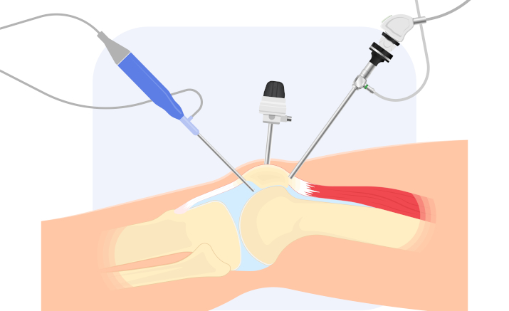 Артроскопия колена