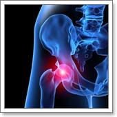 коксартроз