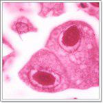 Цитомегаловирус