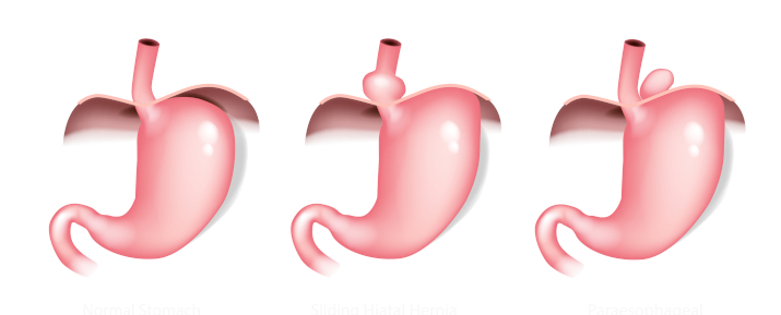 Грыжа пищеводного отверстия диафрагмы Грыжа пищеводного отверстия диафрагмы