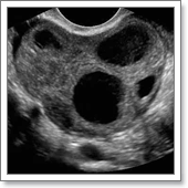 УЗИ малого таза