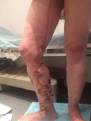 Варикозное расширения вен