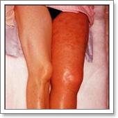 лечение варикоза