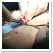 минифлебэктомия