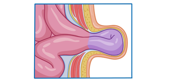 Грыжа Грыжа