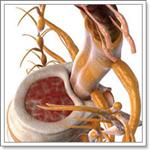 Симптомы радикулита