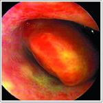 Причины возникновения полипов эндометрия