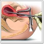 Лечение полипов эндометрия