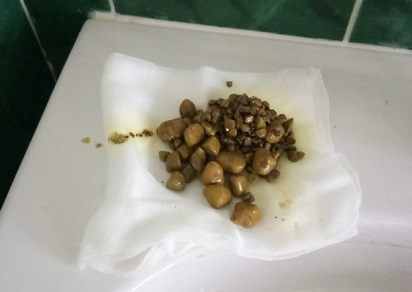 Камни в желчном пузыре