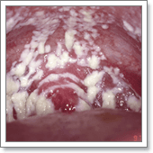 кандидоз, молочница, симптомы кандидоза