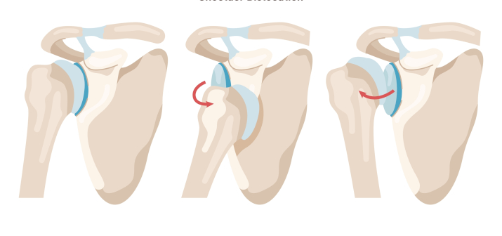 Вывих плеча
