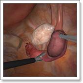 сальпингэктомия