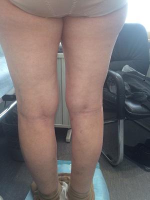 Результат лечения варикозного расширения вен методом венэктомии