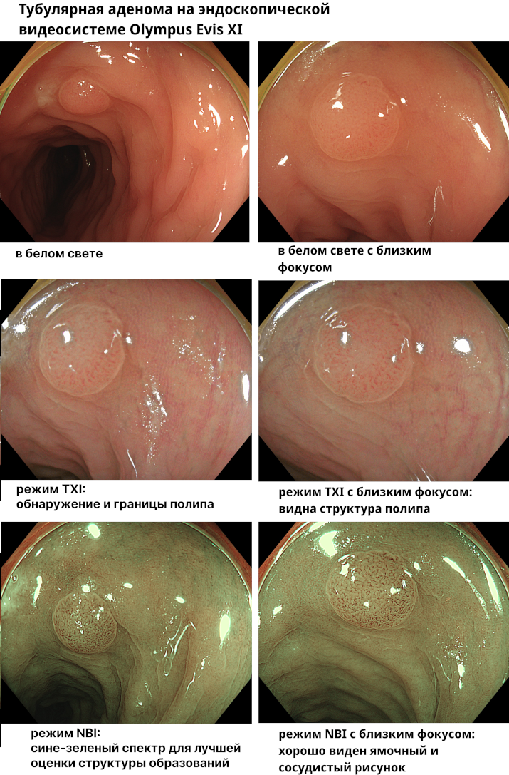 Тубулярная аденома Тубулярная аденома