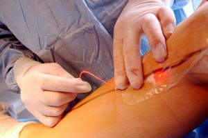 Эндовенозная лазерная коагуляция (ЭВЛК)