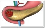 Рак поджелудочной железы