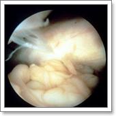 артроскопия коленного сустава