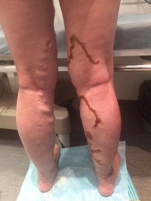 Варикозное расширения вен