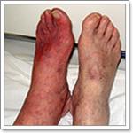 атеросклероз