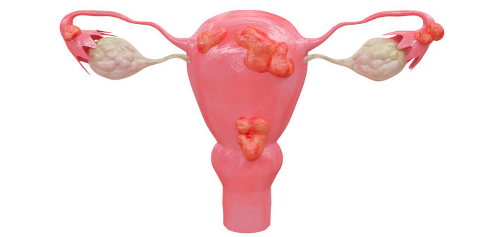 Эндометриоз