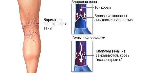 Клапаны варикозных вен