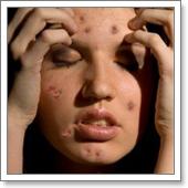 симптомы гиперандрогении, акне, прыщи