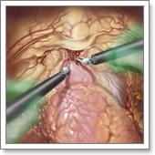 лечение рака простаты