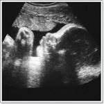 УЗИ при беременности