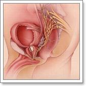 радикальная простатэктомия