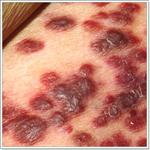 опухоли женских половых органов