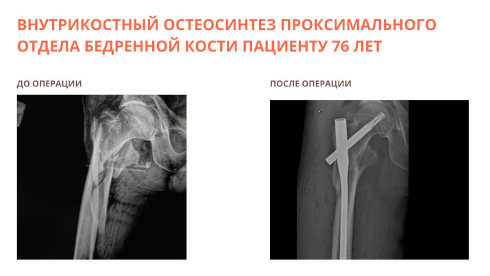 Остеосинтез