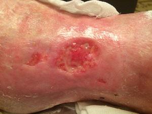 Трофическая язва