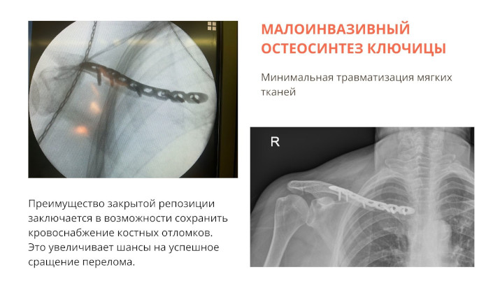 Остеосинтез